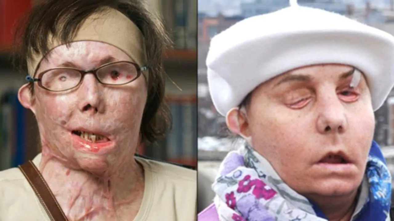 Carmen Tarleton thanks donor’s family for face transplant