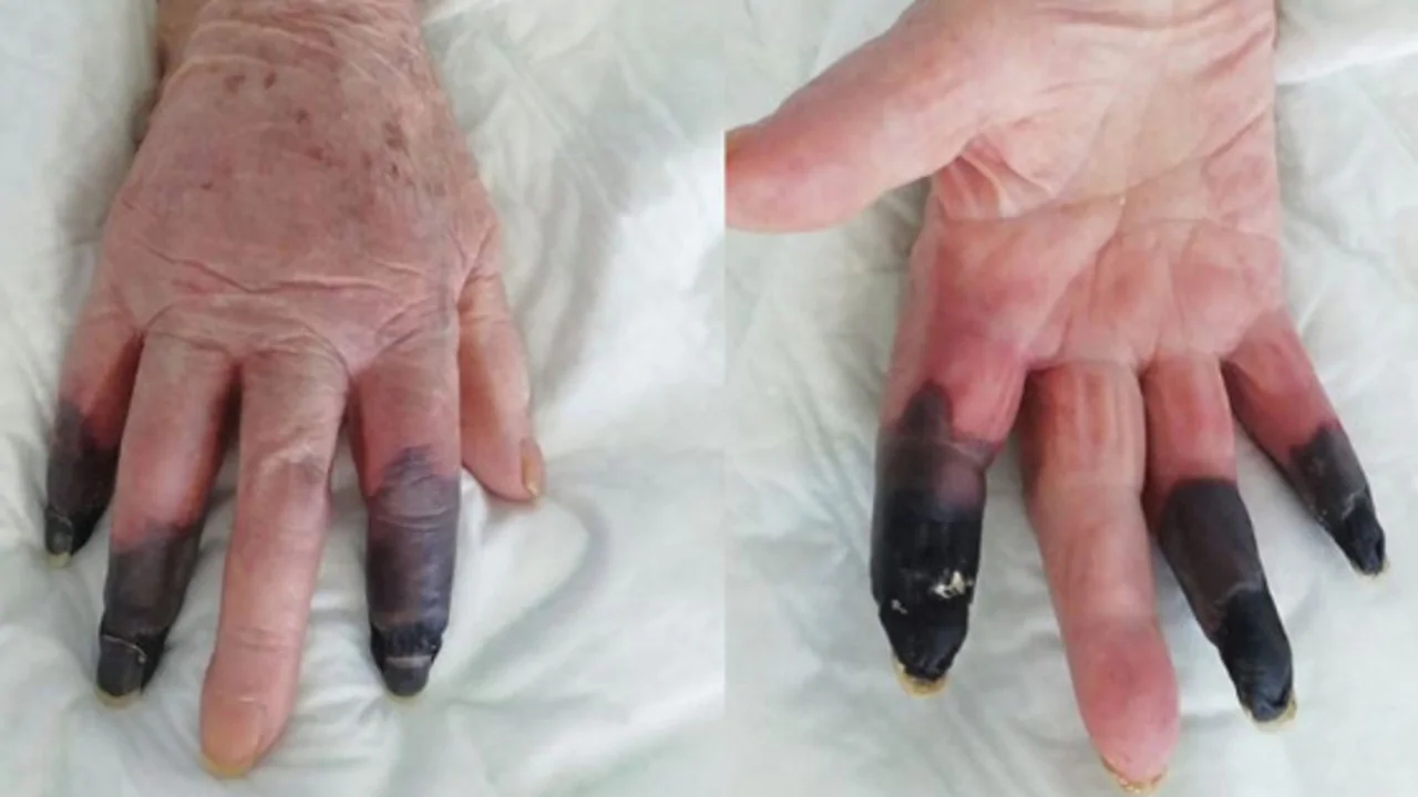 Italian woman has fingers amputated after bizarre COVID-19 symptoms cause gangrene