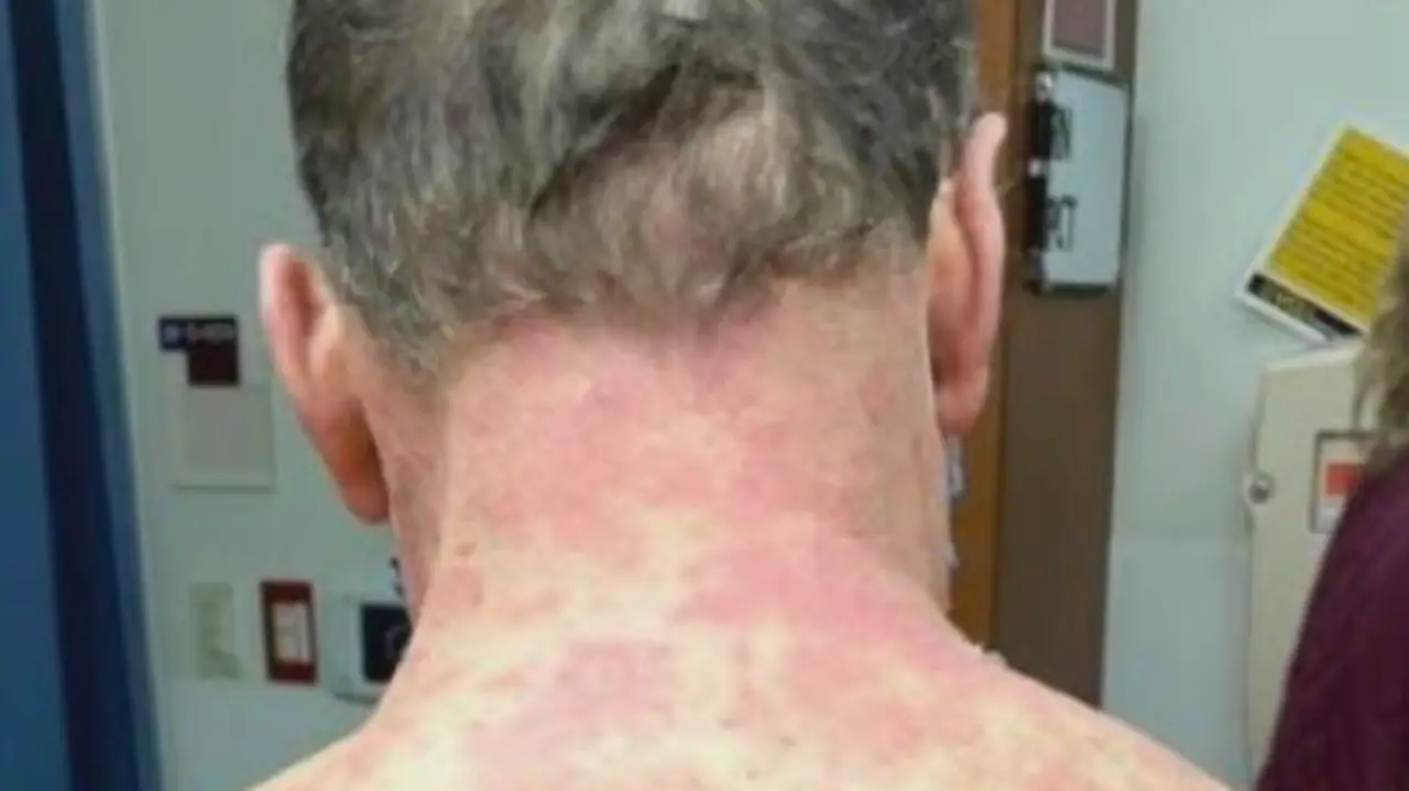 Man’s ‘skin peeled off’ after Johnson & Johnson covid vaccine