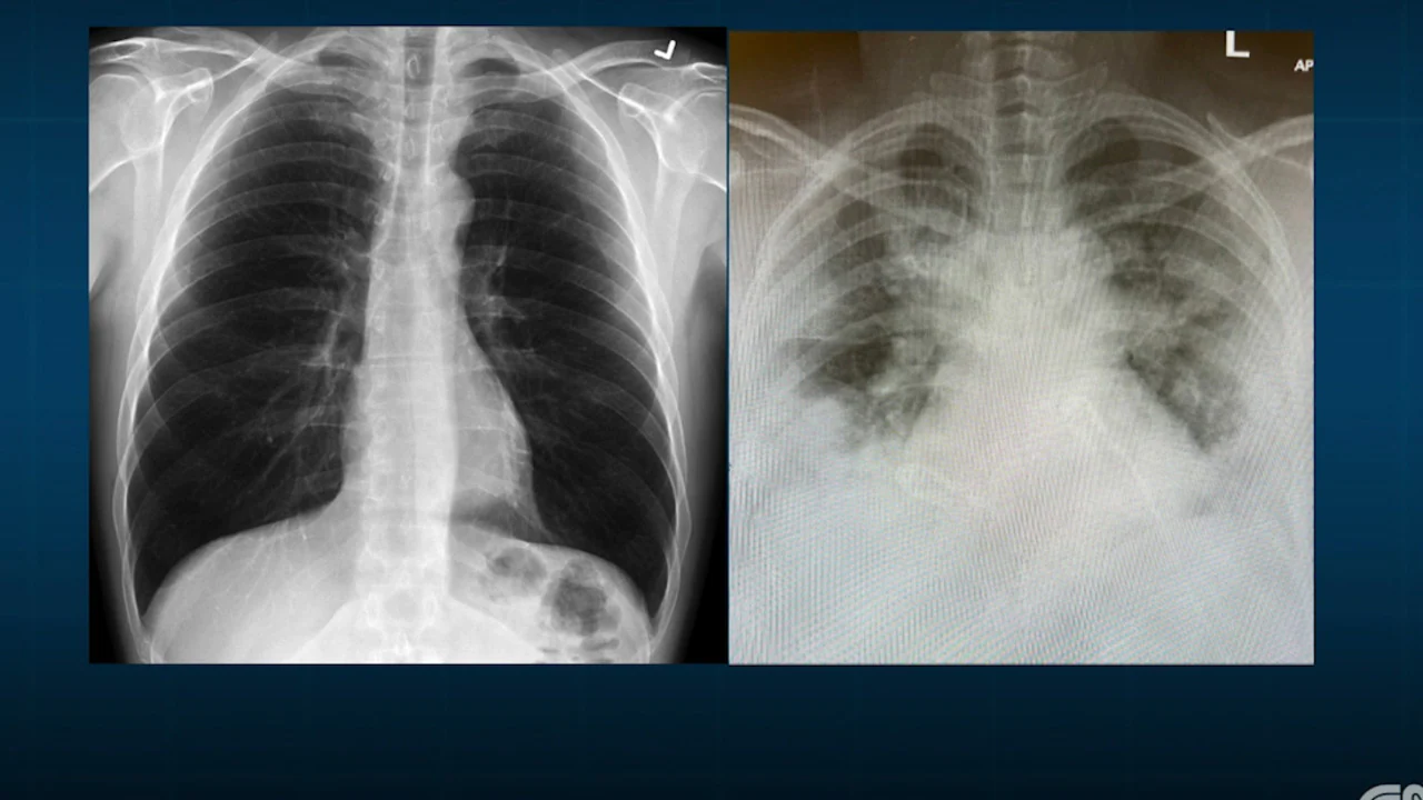 COVID-19 variants from UK, Brazil, South Africa infecting young people and making them sick in great numbers