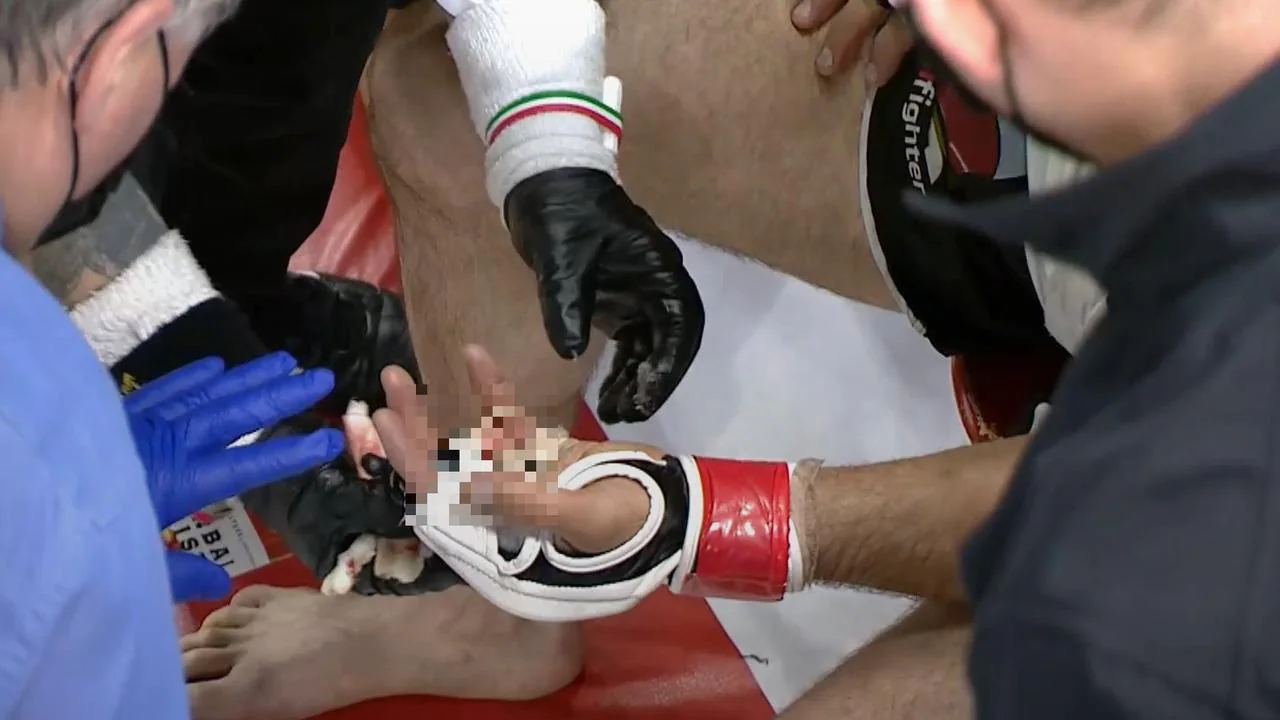 Khetag Pliev finger injury, CFFC94 results